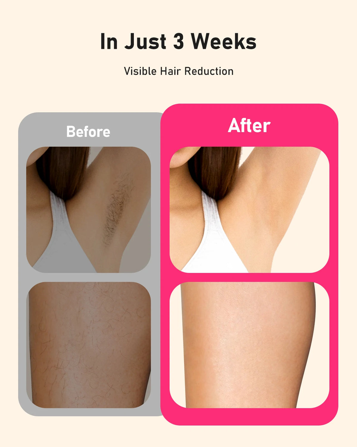 JOOYEE IPL Laser Hair Remover Permanent At Home Epilator Machine